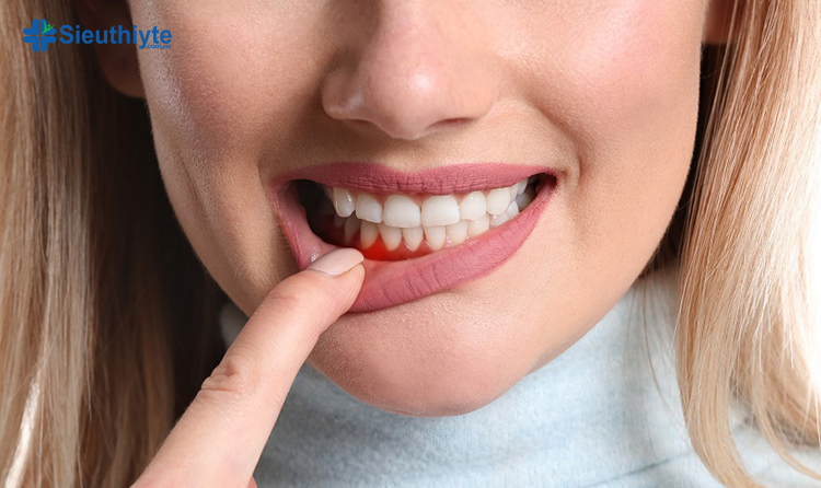 Viêm nướu răng là một biến chứng tiểu đường ở răng