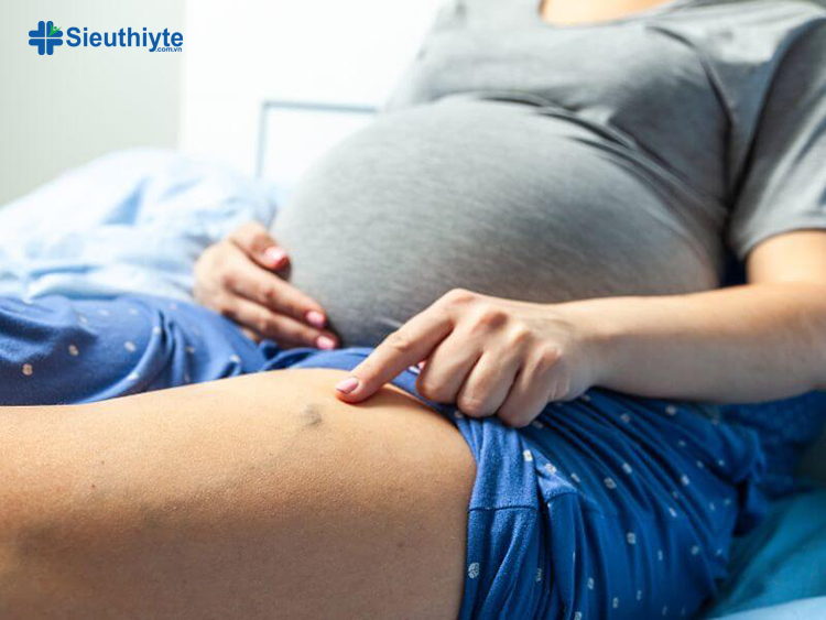 Mang thai dẫn đến nồng độ hormone và lượng máu tăng cao, từ đó khiến các tĩnh mạch nông bị giãn to ra