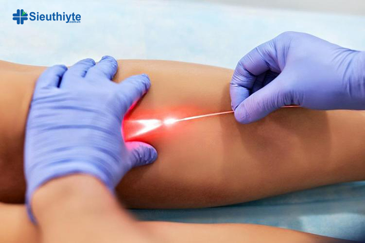 Can thiệp nội mạch bằng laser là kỹ thuật điều trị giãn tĩnh mạch nông chi dưới ít gây đau