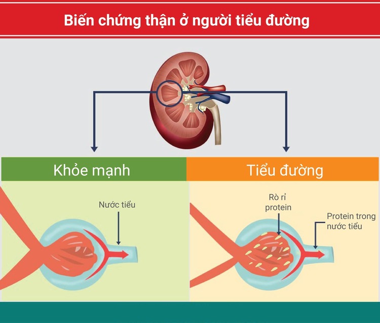 thuoc dieu tri tieu duong tuyp 2 3