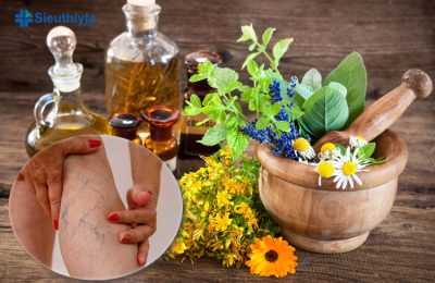 Cây thuốc nam chữa suy giãn tĩnh mạch hiệu quả
