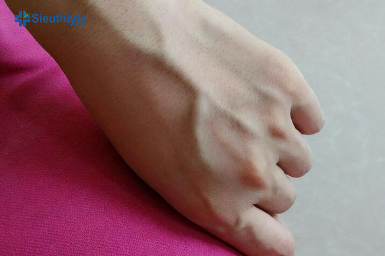 Nổi gân xanh ở bàn tay và tay