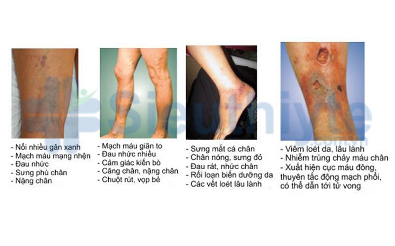 biến chứng giãn tĩnh mạch