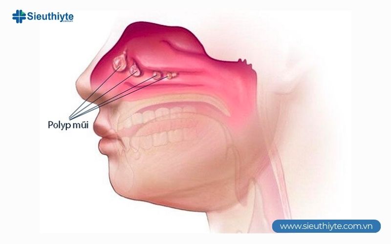 Polyp mũi thường không tự hết và cần điều trị kịp thời, nếu không, chúng có thể phát triển lớn và gây nghẹt mũi, mất khứu giác hoặc viêm xoang mạn tính. Polyp mũi thường không tự hết và cần điều trị kịp thời, nếu không, chúng có thể phát triển lớn và gây nghẹt mũi, mất khứu giác hoặc viêm xoang mạn tính.