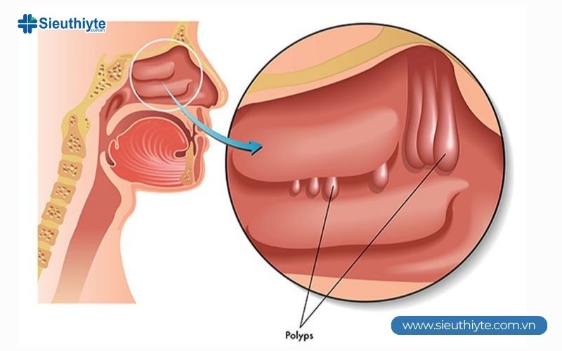 Polyp mũi có 4 phân độ dựa vào kích thước và tình trạng phát triển của chúng Polyp mũi có 4 phân độ dựa vào kích thước và tình trạng phát triển của chúng