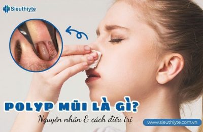 Polyp mũi là gì? Nguyên nhân và cách điều trị