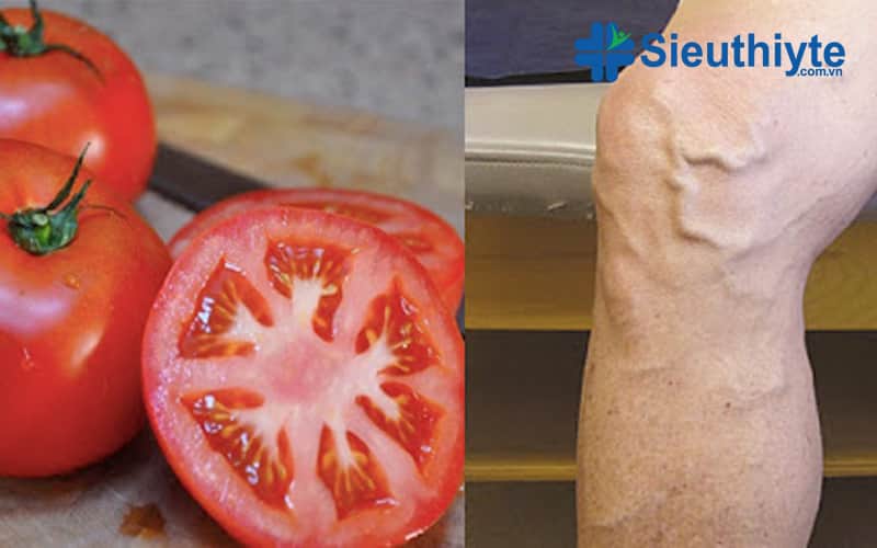 chữa giãn tinh mạch bằng cà chua tại nhà