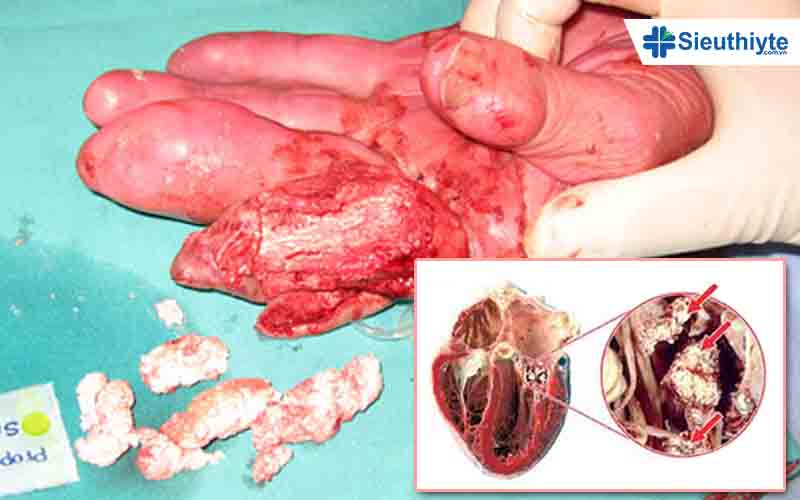 Biến chứng của bệnh gút tại tim