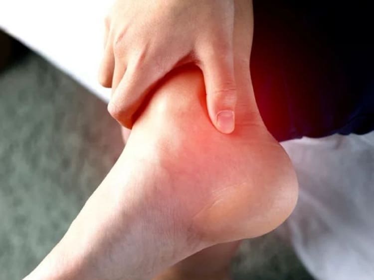 Bệnh gout nếu không được điều trị sẽ tạo thành các hạt tophi 