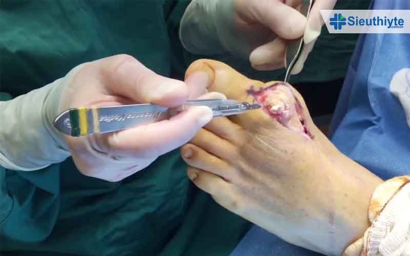 Phẫu thuật cắt cục tophi ở ngón chân