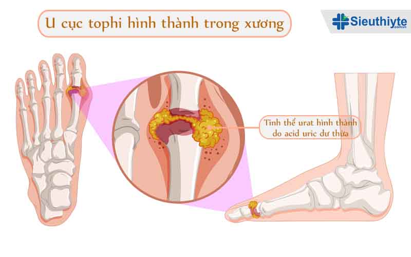 Cục u tophi là gì?