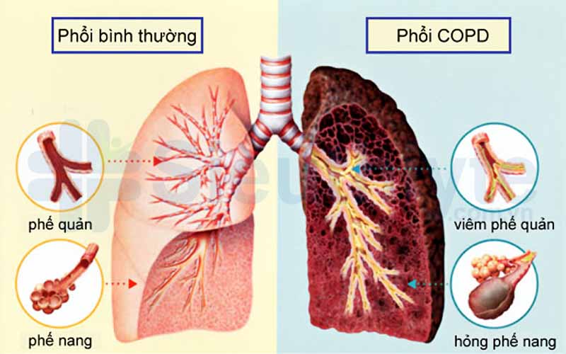 Máy hỗ trợ thở là gì? Máy hỗ trợ thở là gì?
