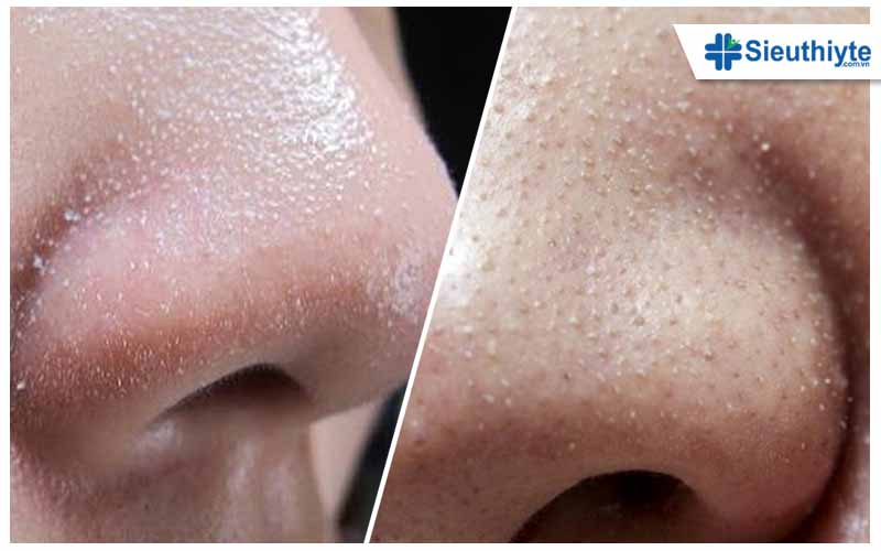 Bạn đã biết cách trị mụn cám ở mũi tận gốc?