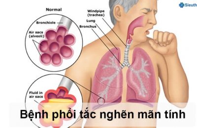 giai doan benh phoi tac nghen man tinh min 1
