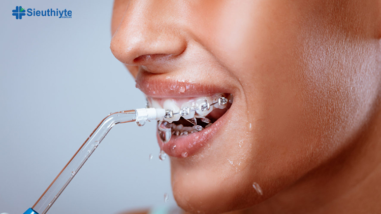 Máy tăm nước cho người niềng răng mang đến hiệu quả làm sạch răng gấp 3 lần