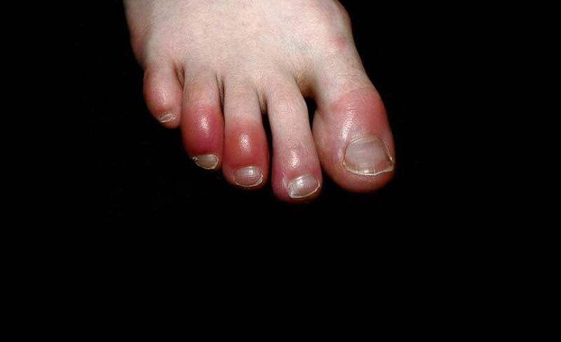 Ngón chân Covid được xem là triệu chứng mới của bệnh Covid-19. (Ảnh: Internet)