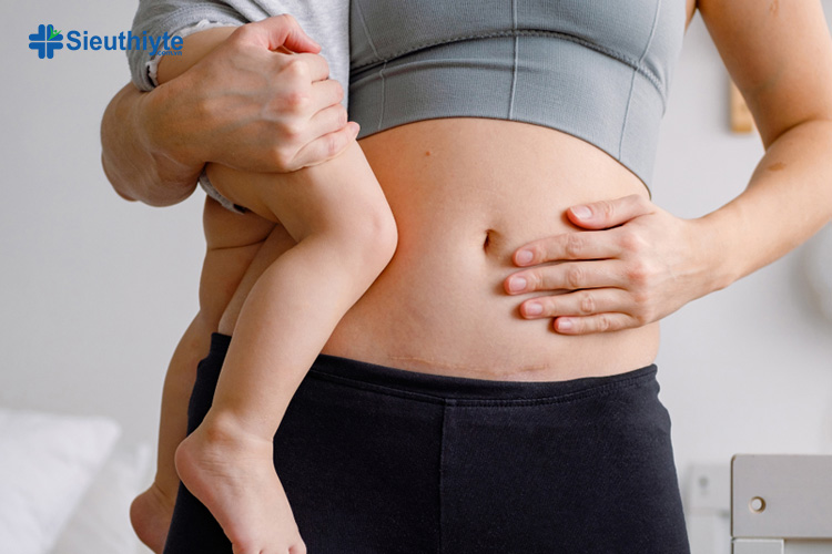 Vội vàng đeo gen bụng sớm sẽ gây nên nhiều hậu quả nghiêm trọng cho mẹ sau sinh