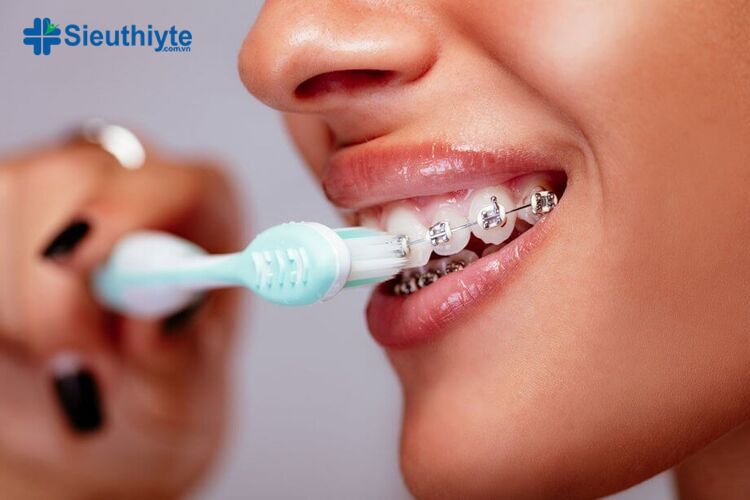 Chăm sóc răng miệng khi niềng răng có thể ngăn ngừa thiệt hại cho mắc cài và răng