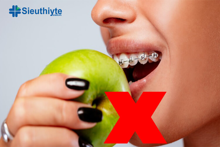 Người niềng răng không nên cắn trực tiếp thực phẩm cứng như táo