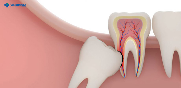 Những chiếc răng hàm thứ ba đông đúc bị mắc kẹt và tạo ra răng mọc ngầm