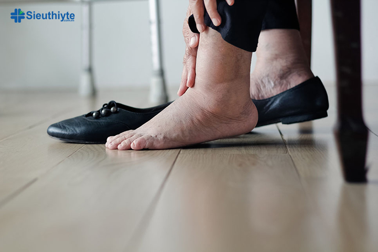 Phù chân ở người già thường được gọi là viêm và phù xảy ra ở người lớn tuổi