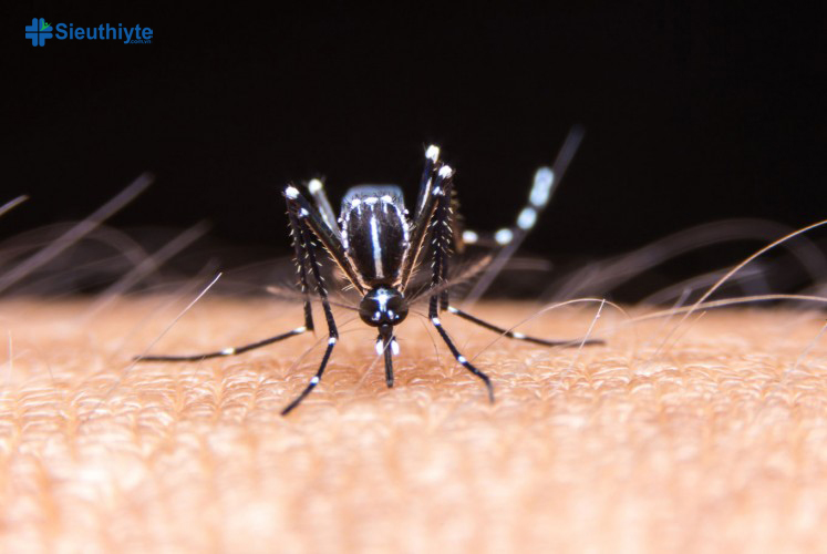 Sốt xuất huyết là bệnh do muỗi vằn mang vi rút sốt xuất huyết gây ra