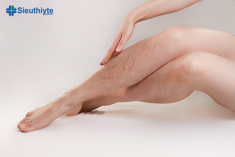 Giãn tĩnh mạch có thể dẫn đến các triệu chứng như đau nhức, nhói hoặc chuột rút ở chân 