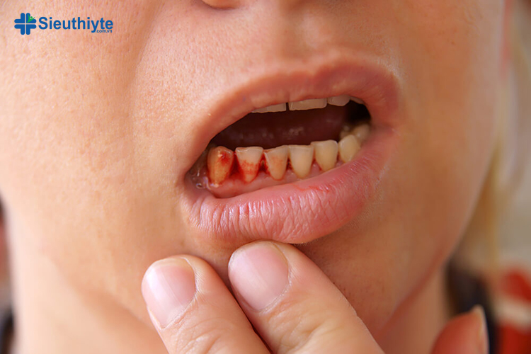 Viêm nha chu là một bệnh nhiễm trùng nướu nghiêm trọng gây chảy máu chân răng
