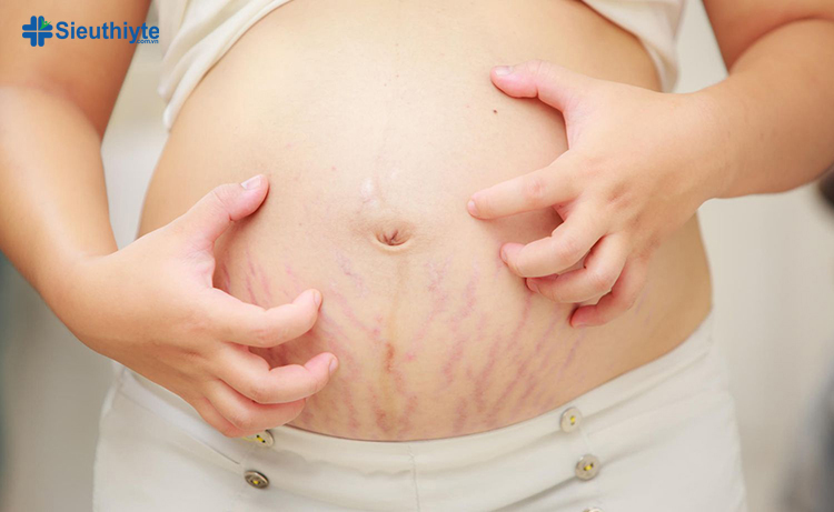 Phụ nữ mang thai cũng thường bị ngứa nhất là ở đùi và bụng