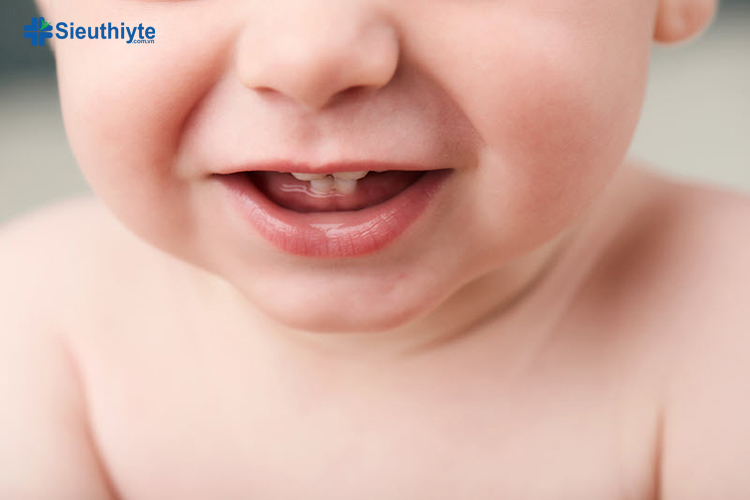 Nguyên nhân phổ biến gây nghiến răng ở trẻ là do răng mọc lệch 