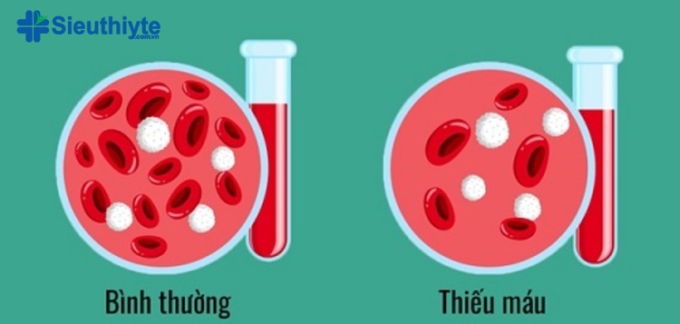 Chỉ số SpO2 được dùng để chẩn đoán bệnh thiếu máu