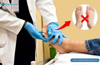 5 Trường hợp cần mổ hạt tophi