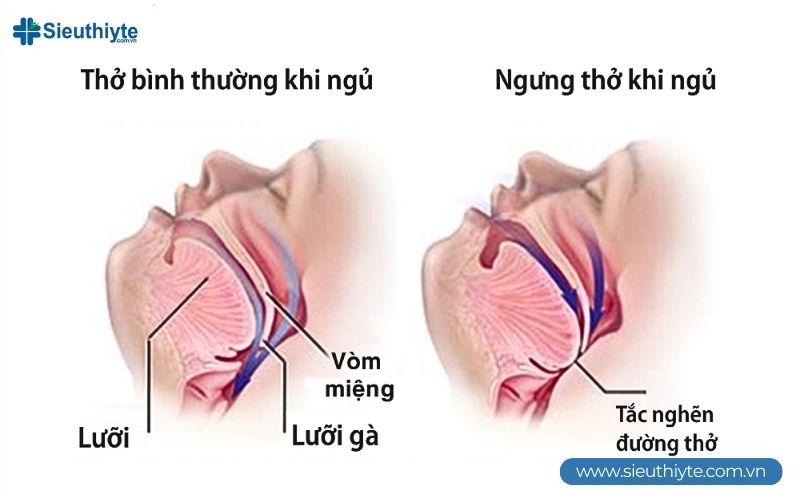 Ngưng thở khi ngủ là một trong những nguyên nhân gây ra tình trạng ngủ ngáy Ngưng thở khi ngủ là một trong những nguyên nhân gây ra tình trạng ngủ ngáy