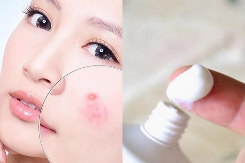 Điều trị mụn - Top 7 công dụng làm đẹp của kem đánh răng