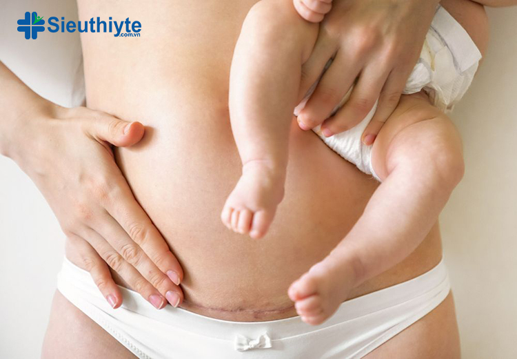Quần gen bụng giúp mẹ bỉm lấy lại vóc dáng sau sinh